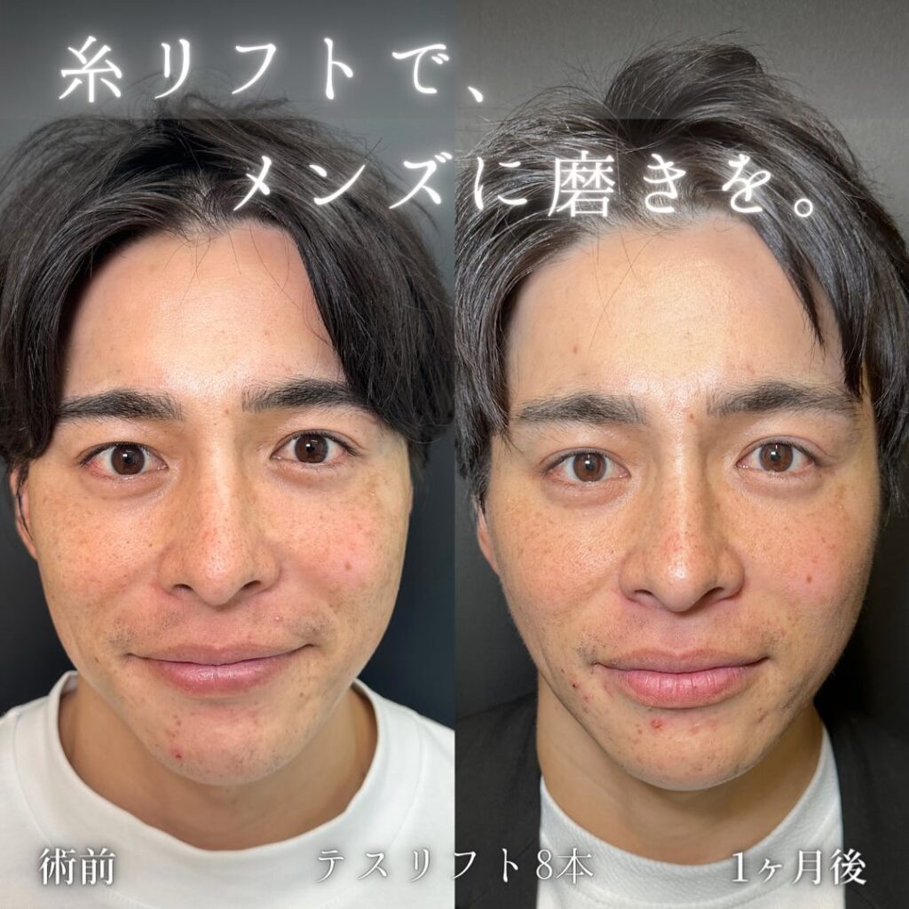 福岡院の男性の糸リフトの症例写真 (1)