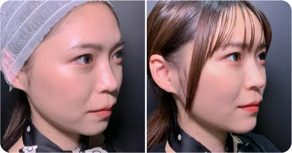 顔脂肪吸引＋糸リフト施の症例写真（名医のeクリニック伊藤渉医師が執刀）