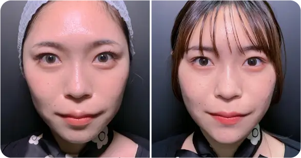 顔脂肪吸引＋糸リフト施の症例写真（名医のeクリニック伊藤渉医師が執刀）