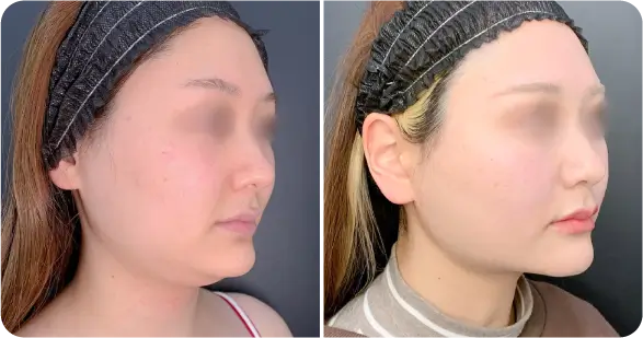 顔脂肪吸引＋糸リフト施の症例写真（名医のeクリニック伊藤渉医師が執刀）