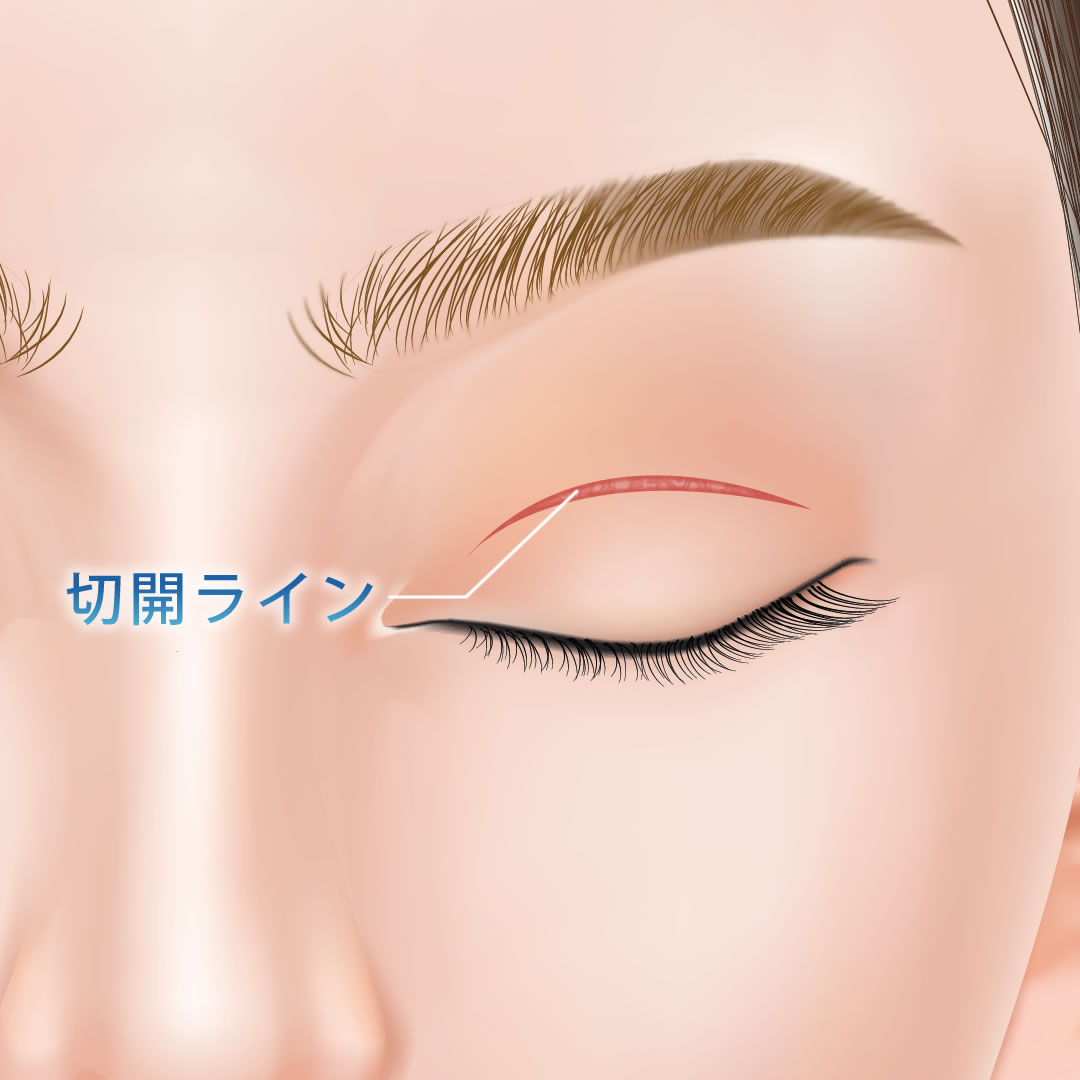 全切開