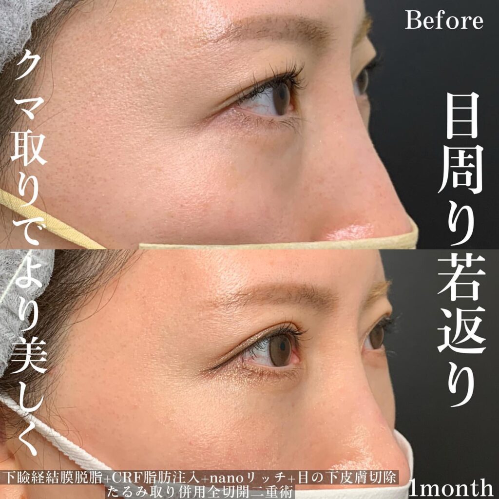 脱脂 たるみ取り 全切開