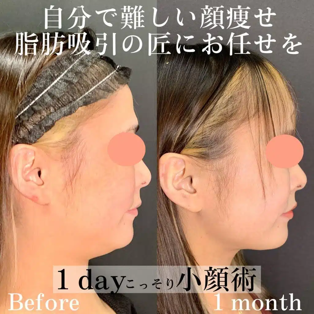 脂肪吸引