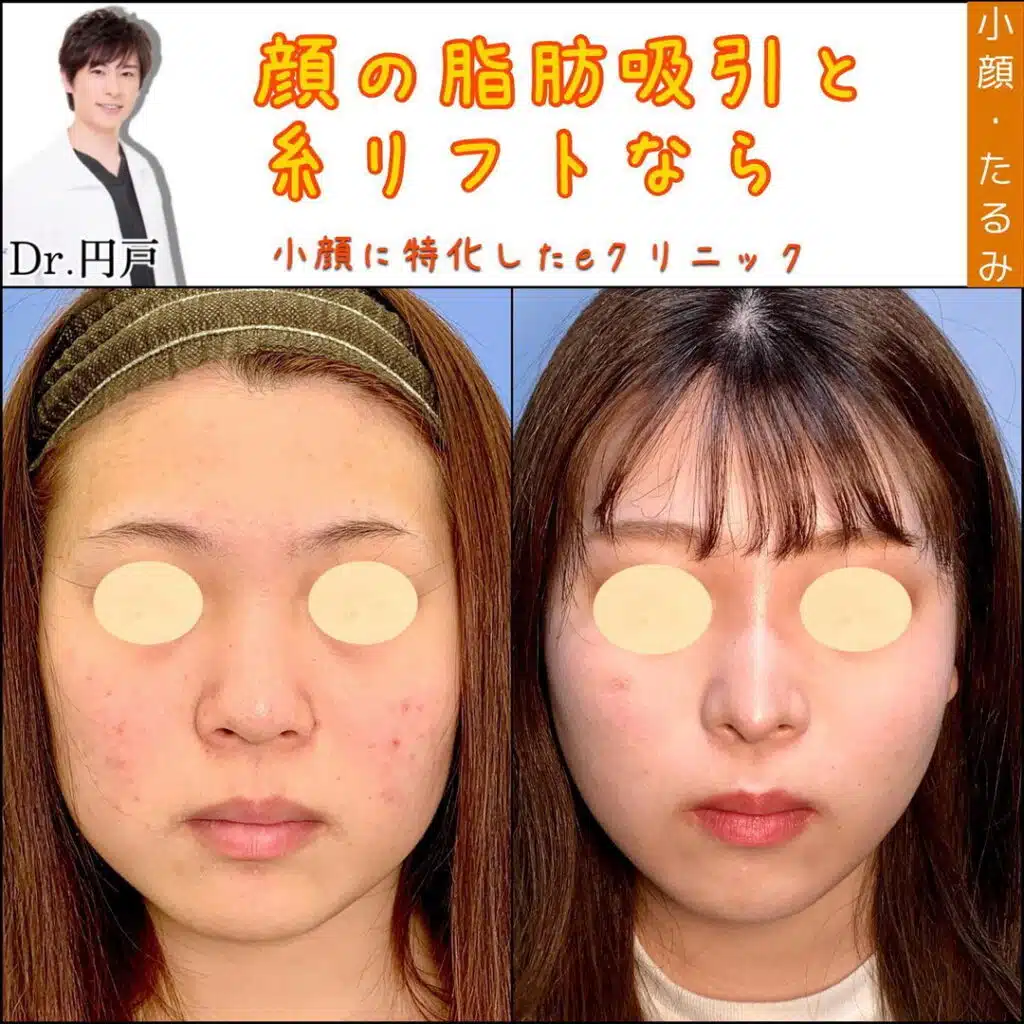 糸リフト