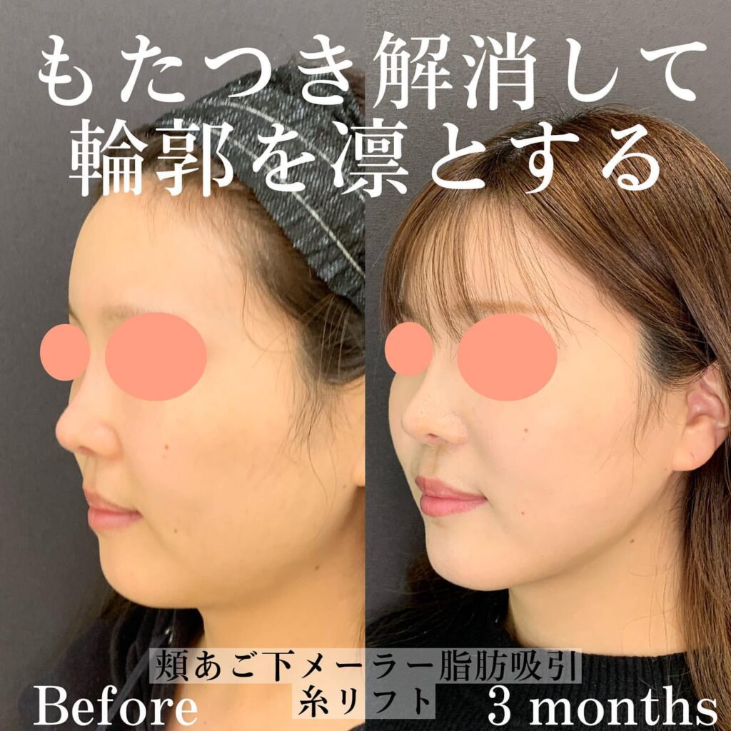 eclinic福岡院の脂肪吸引症例写真