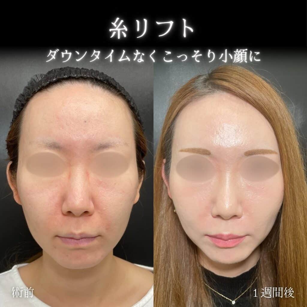 eclinic福岡院の糸リフト症例写真