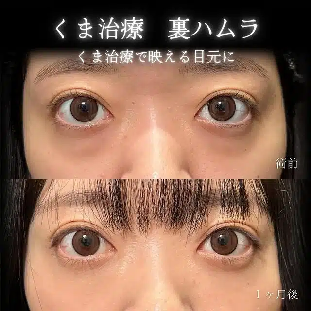 クマ取り（裏ハムラ）　福岡