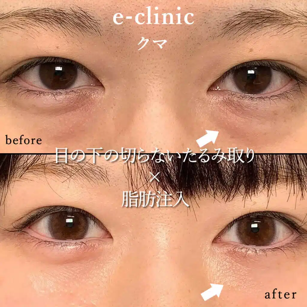 eclinic福岡院の表ハムラの症例画像（1）