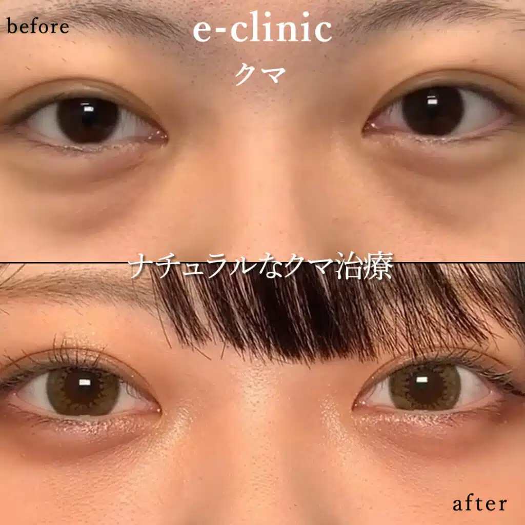 eclinic福岡院の表ハムラの症例画像（2）