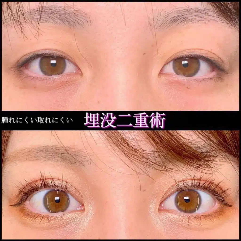 二重埋没法　福岡