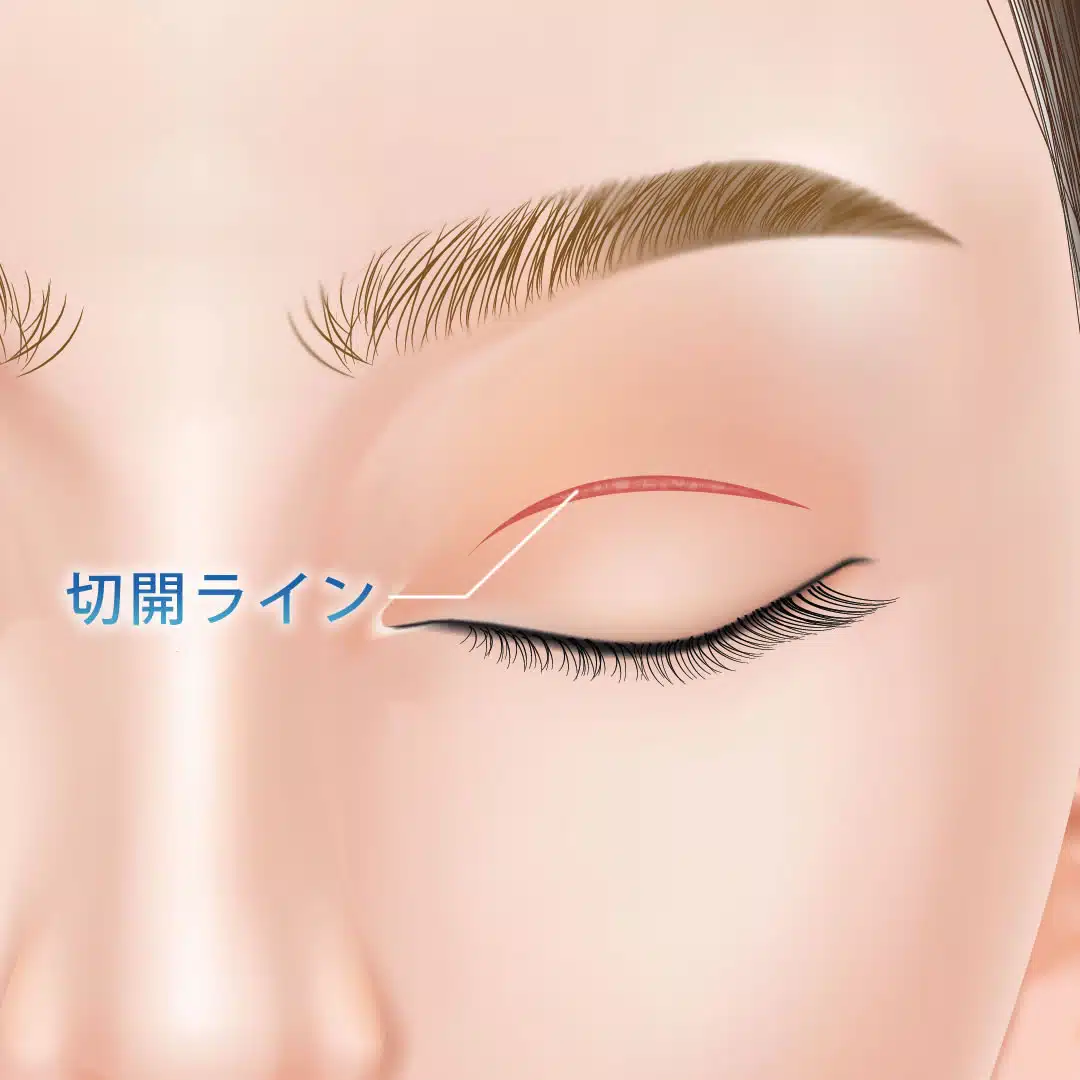 二重全切開　福岡