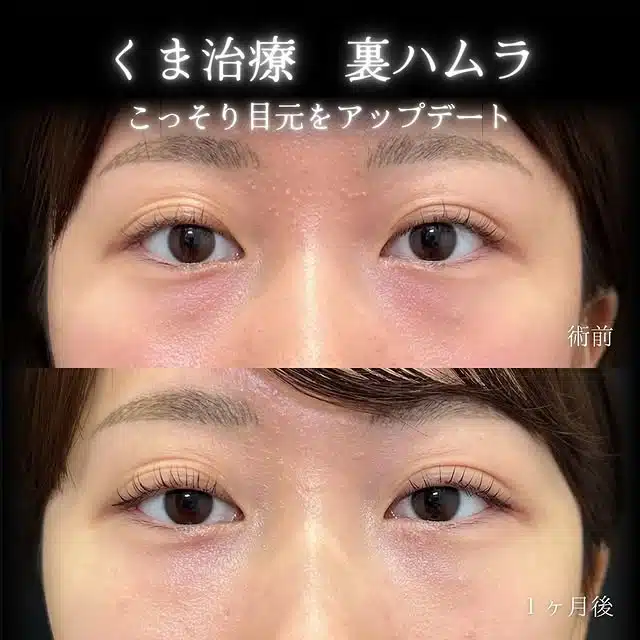 クマ取り（裏ハムラ）　福岡