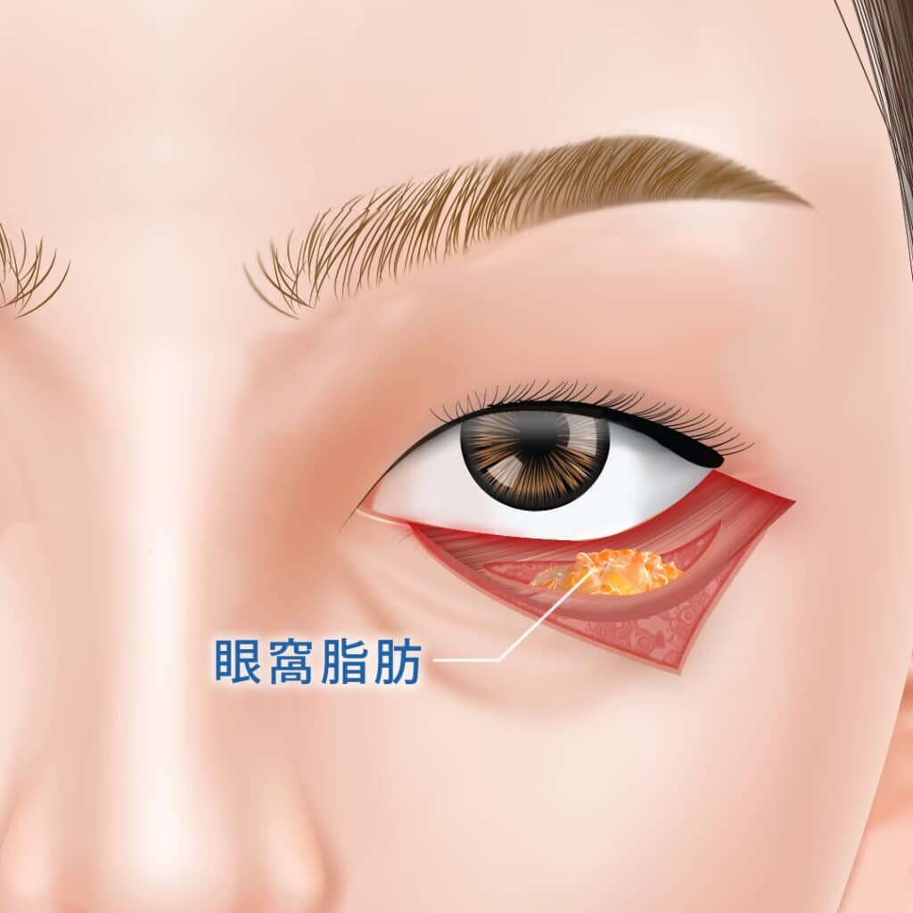 表ハムラで眼窩脂肪を出している図解