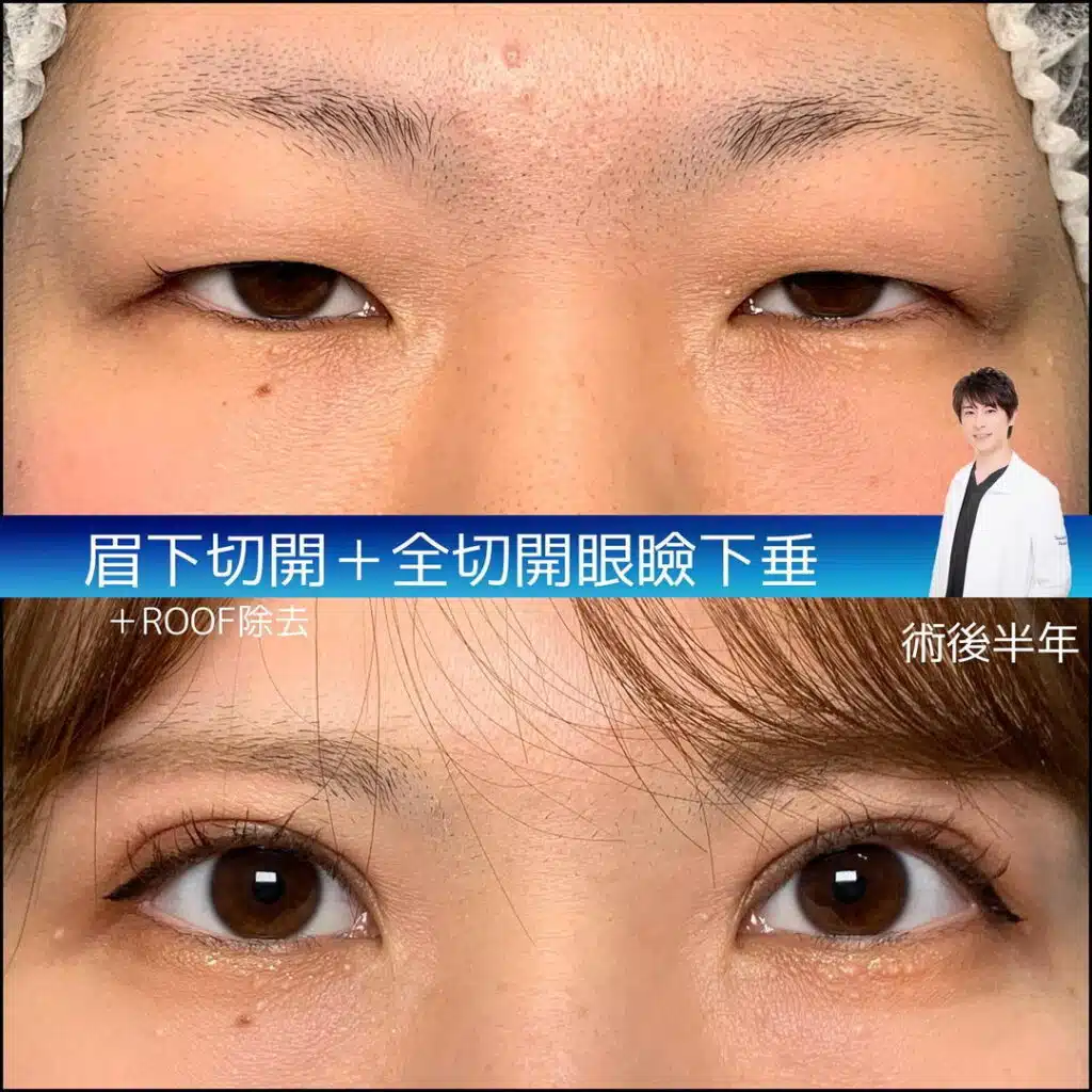 眼瞼下垂手術（目つき矯正）　福岡