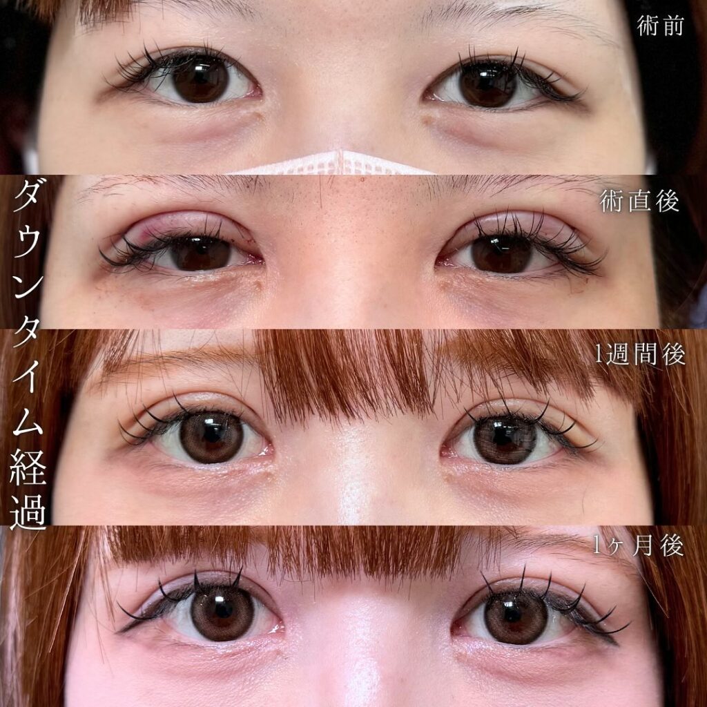 たるみ取り併用全切開のダウンタイムの経過の症例写真