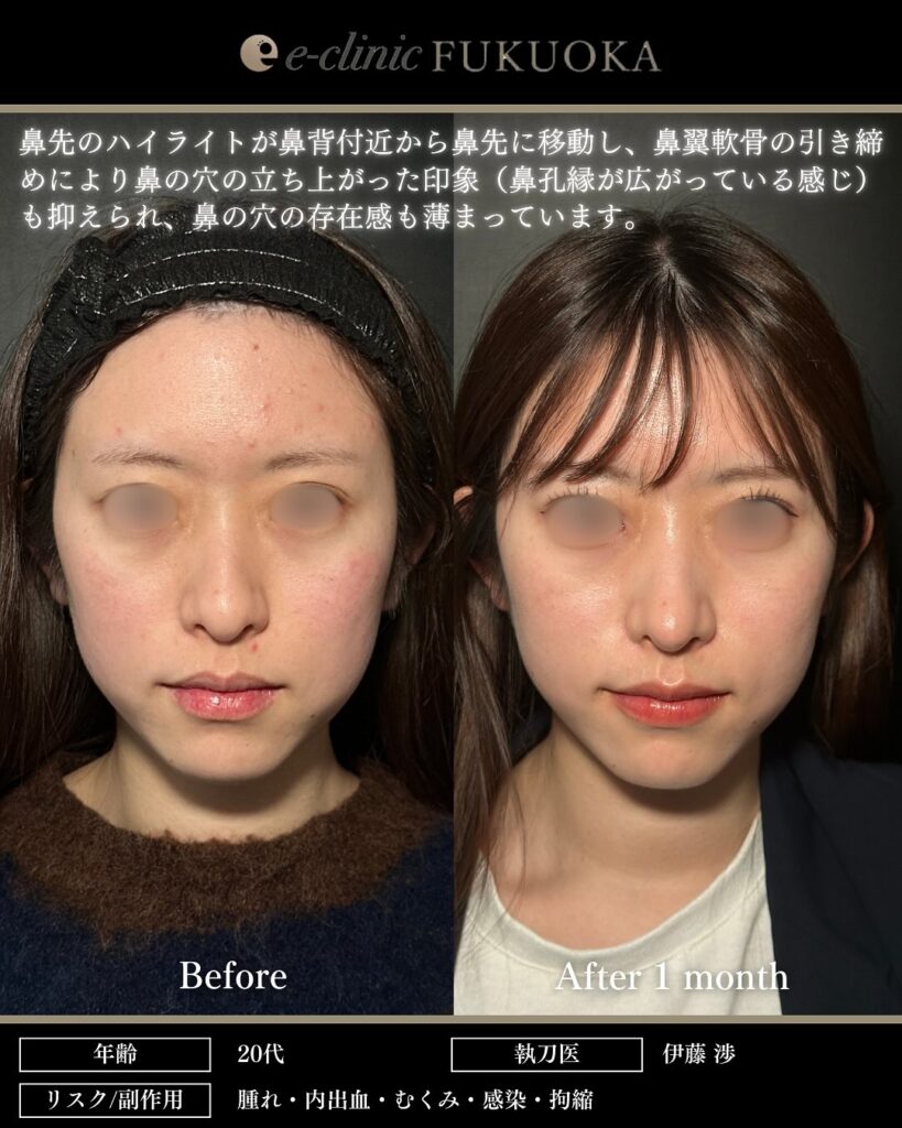 鼻尖形成クローズ法、耳介軟骨移植の症例写真 (2)