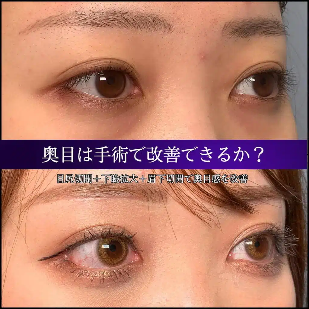 目尻切開　福岡