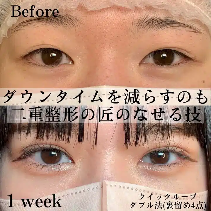 二重整形　福岡