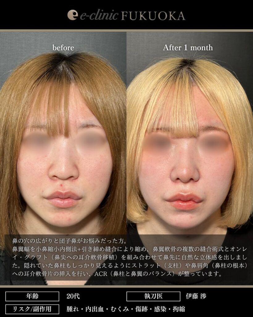 鼻尖形成3D法、耳介軟骨移植、小鼻縮小内側法の症例写真 (3)