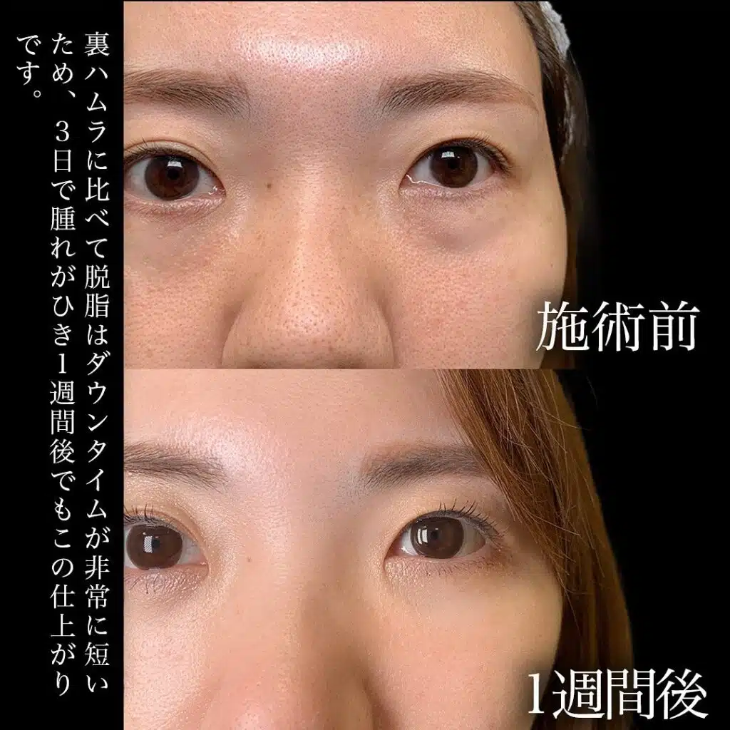 経結膜脱脂　福岡