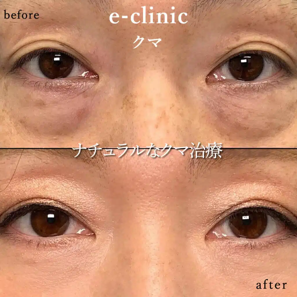 eclinic福岡院の表ハムラの症例画像（3）