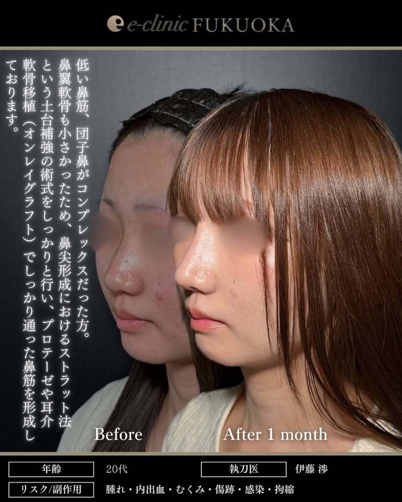 鼻尖形成3D法、耳介軟骨移植、鼻プロテーゼの症例写真 (4)