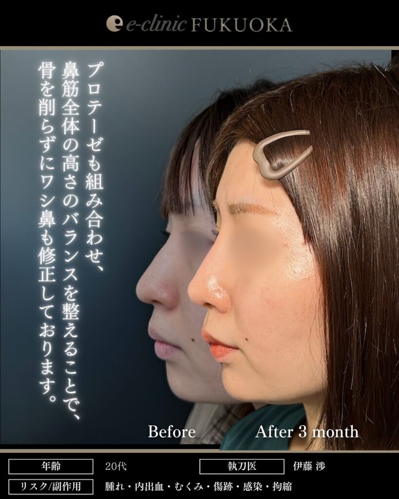 鼻尖形成3D法、耳介軟骨移植、鼻プロテーゼ、小鼻縮小内側法の症例写真 (2)