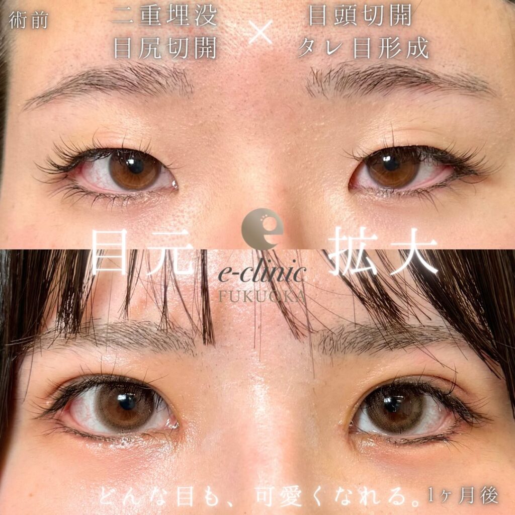 埋没法と目頭切開と目尻切開とタレ目形成の症例写真