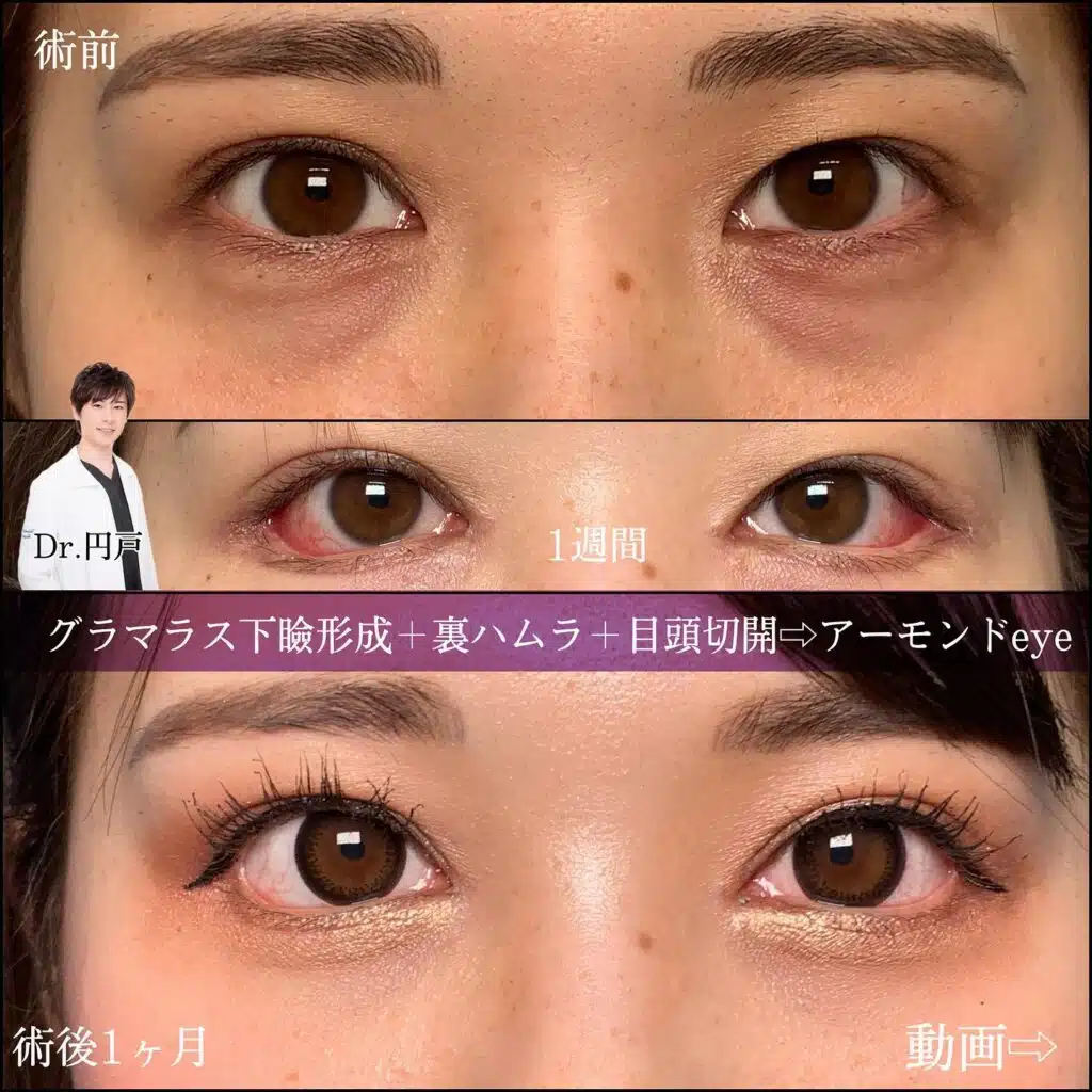グラマラス下瞼形成　裏ハムラ　目頭切開　福岡