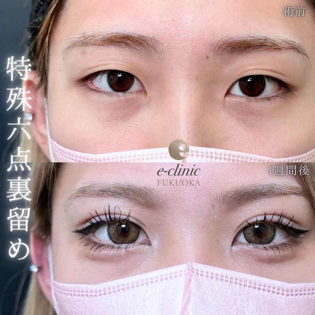 埋没法の症例写真 (10)