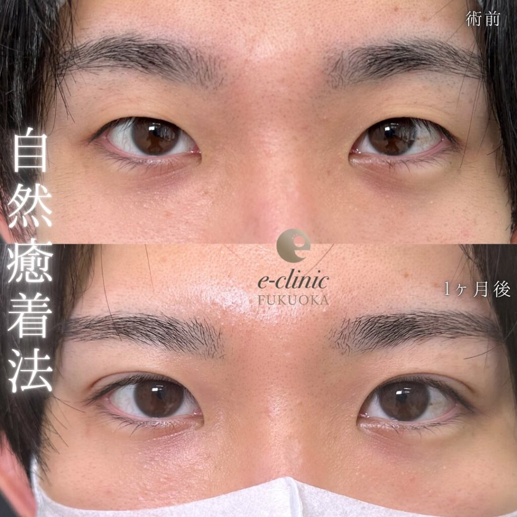 自然癒着法の症例写真 (4)