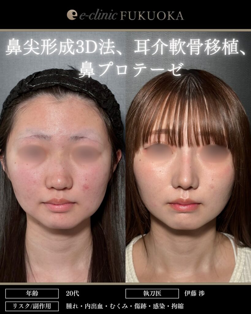 鼻尖形成3D法、耳介軟骨移植、鼻プロテーゼの症例写真 (1)