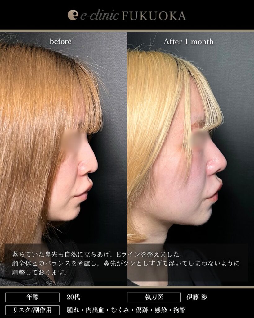 鼻尖形成3D法、耳介軟骨移植、小鼻縮小内側法の症例写真 (4)