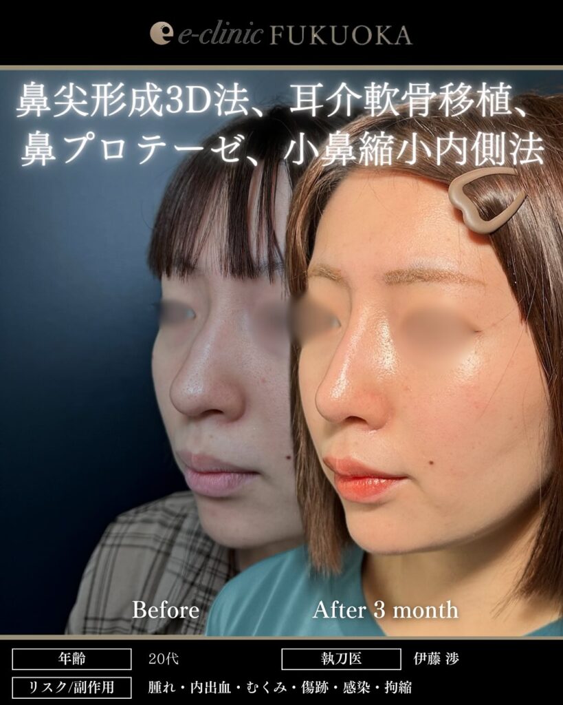鼻尖形成3D法、耳介軟骨移植、鼻プロテーゼ、小鼻縮小内側法の症例写真 (1)