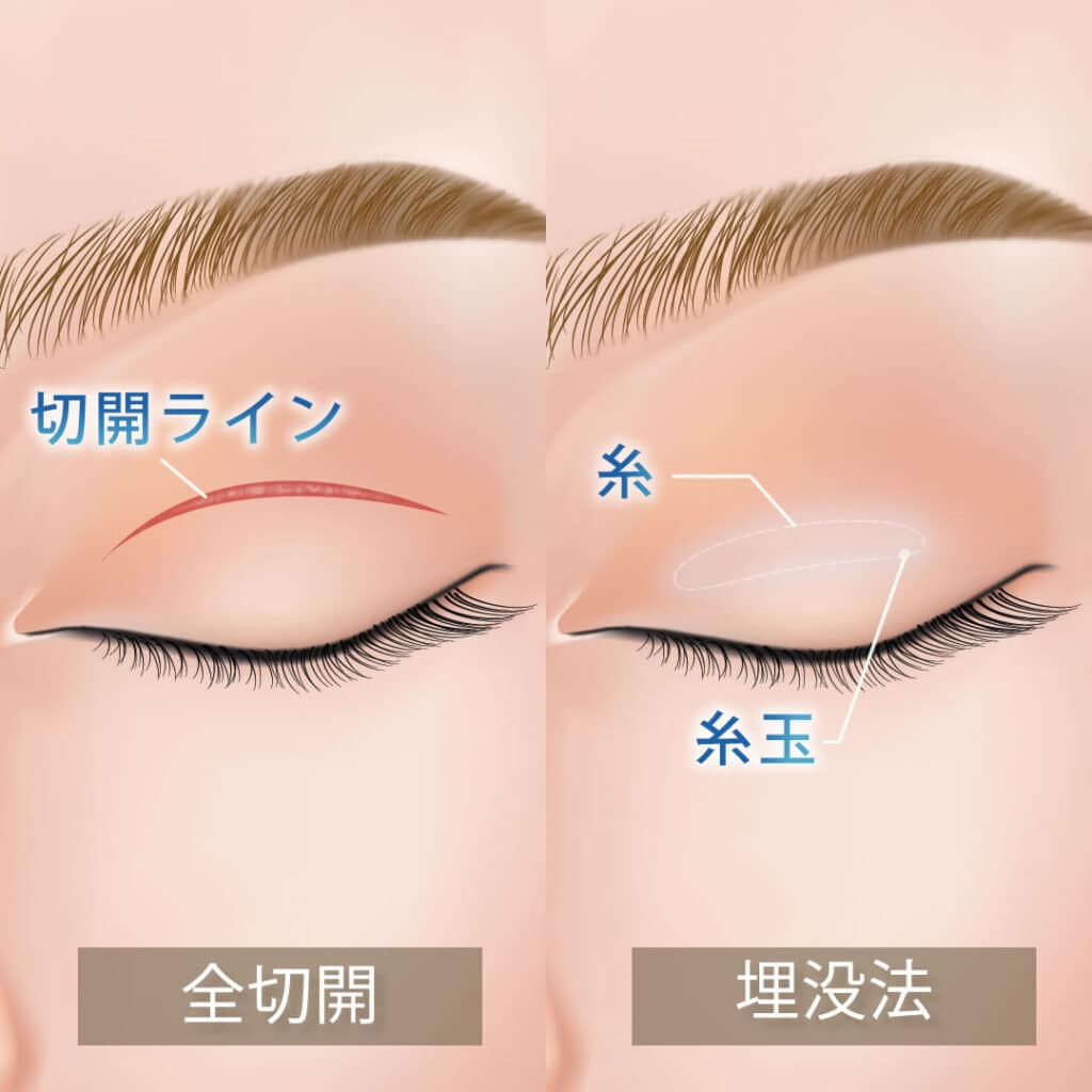 二重整形