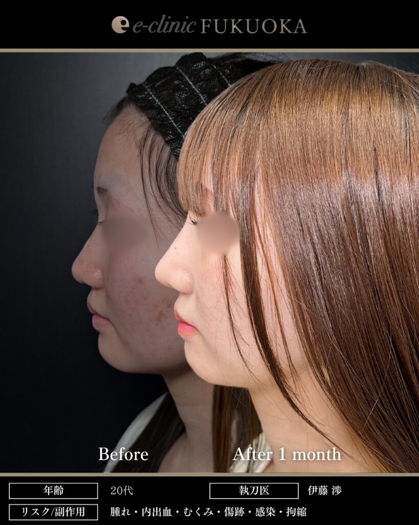 鼻尖形成3D法、耳介軟骨移植、鼻プロテーゼの症例写真 (3)