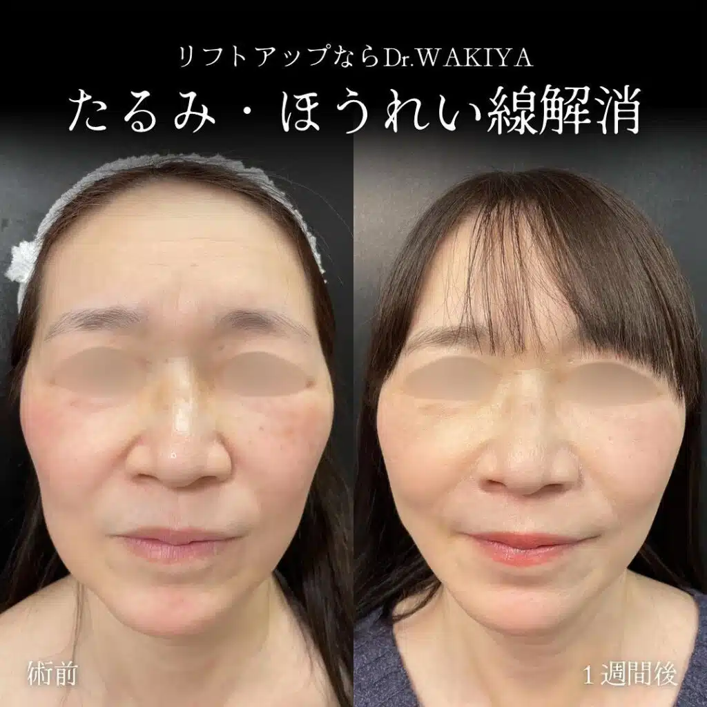 たるみ・ほうれい線解消　福岡