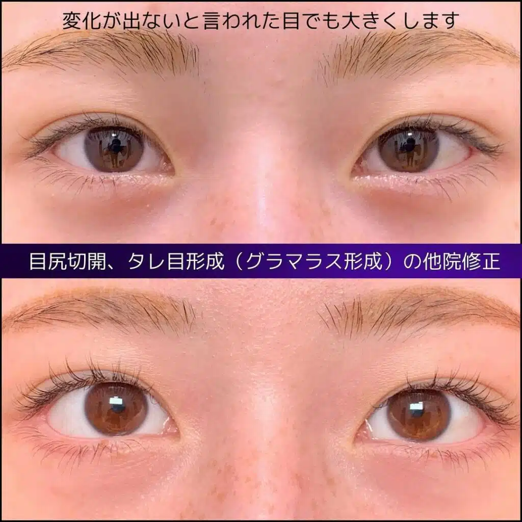 グラマラスライン形成　福岡