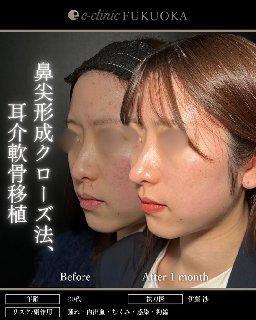 鼻尖形成クローズ法、耳介軟骨移植の症例写真 (4)