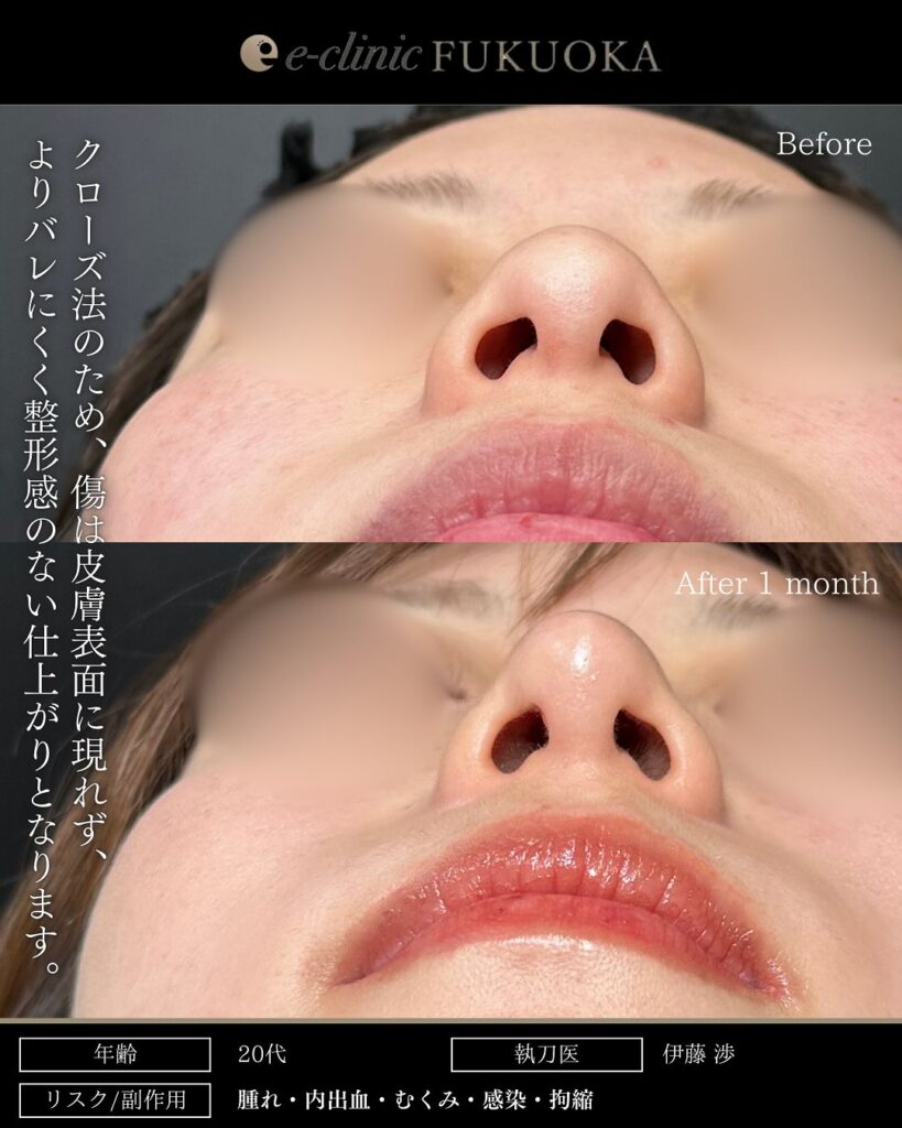 鼻尖形成クローズ法、耳介軟骨移植の症例写真 (1)