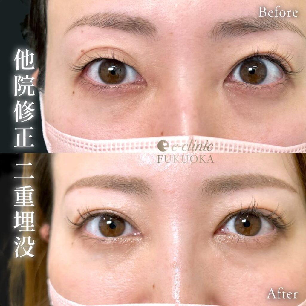 二重埋没と他院修正の症例写真