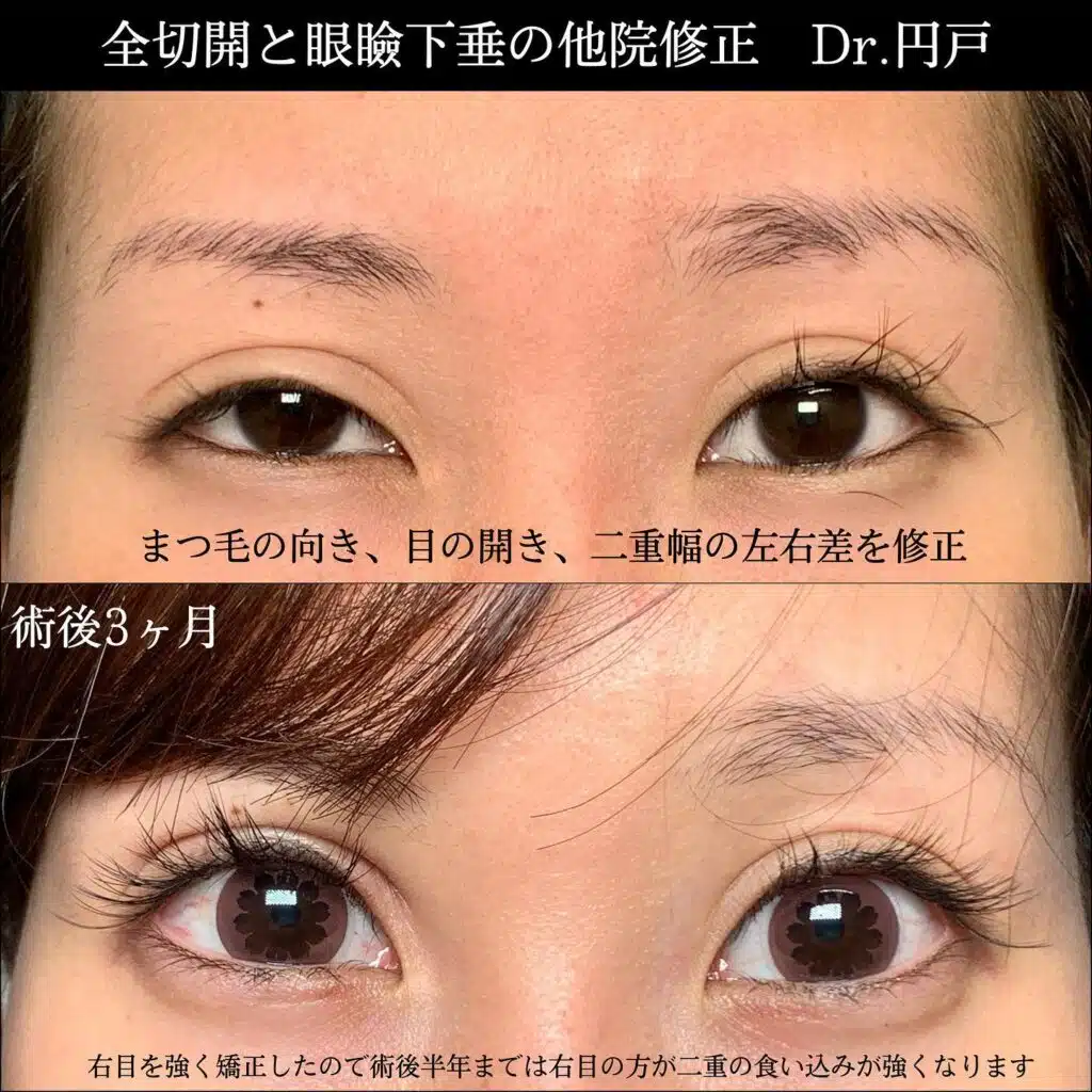 全切開　眼瞼下垂　福岡