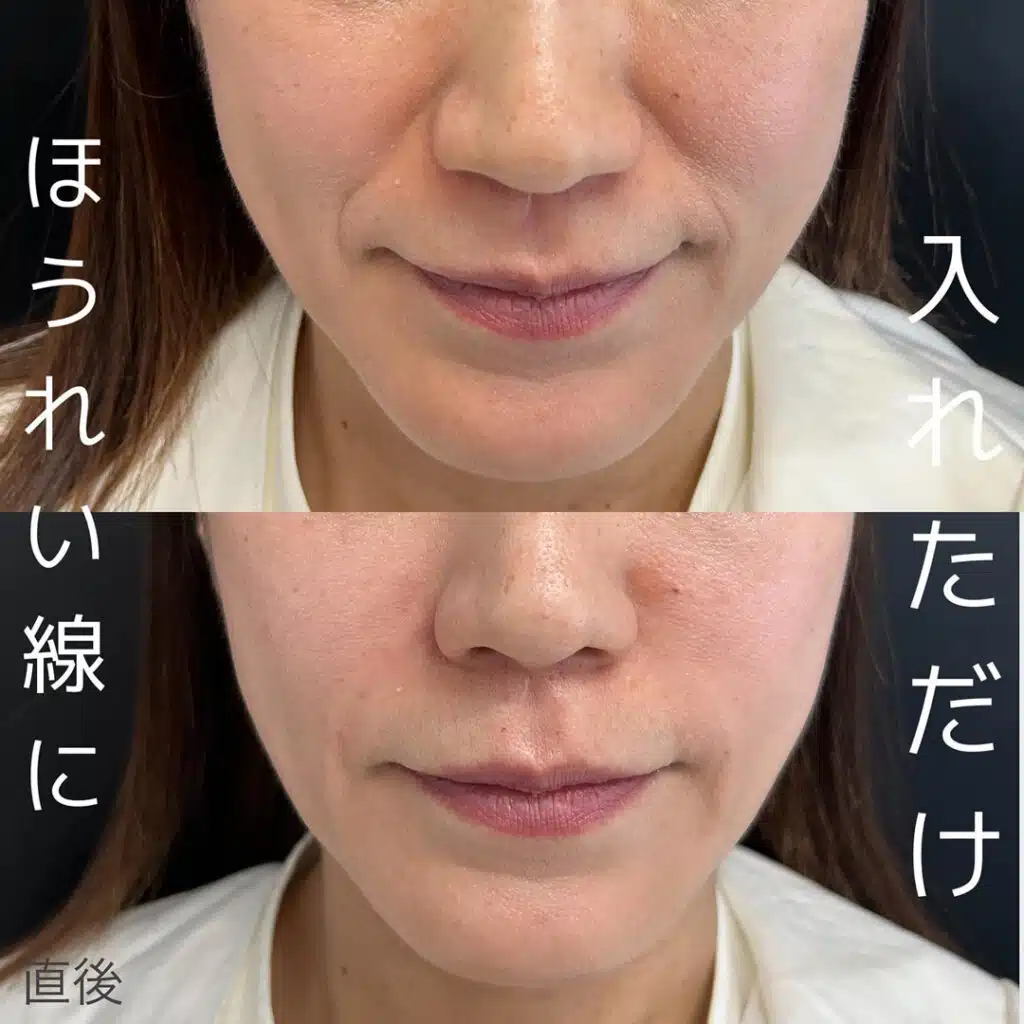 ほうれい線に入れただけ　福岡　
