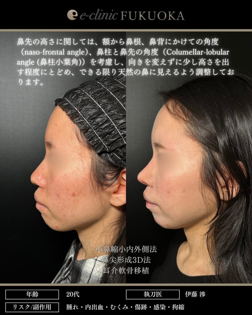 鼻尖形成3D法、耳介軟骨移植、小鼻縮小内外側法の症例写真 (3)