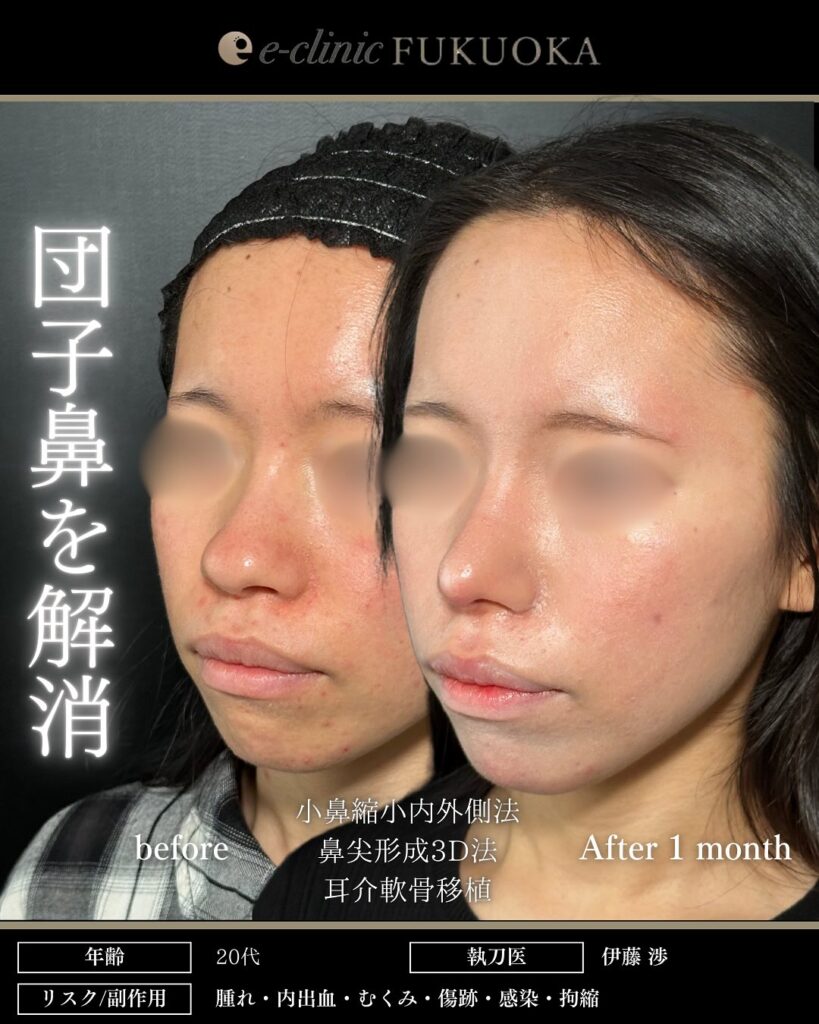 鼻尖形成3D法、耳介軟骨移植、小鼻縮小内外側法の症例写真 (1)