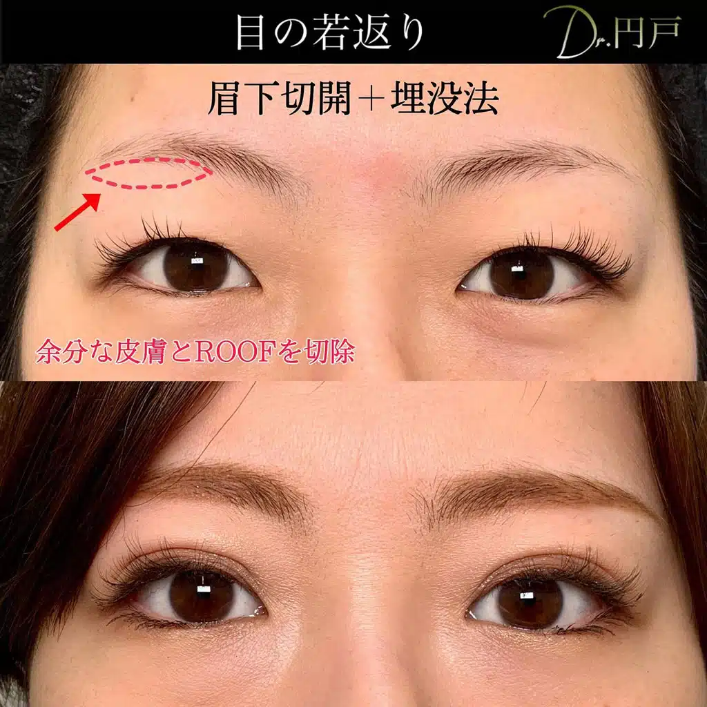眉下切開　埋没法　福岡