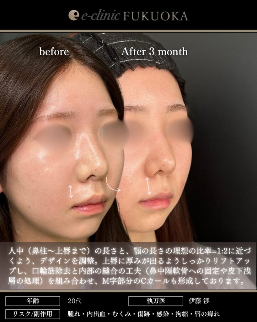 切開法による人中短縮術(口輪筋除去、鼻中隔固定、Cカール形成含む)の症例 (3)
