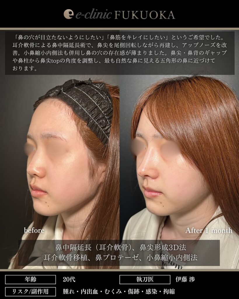 鼻中隔延長(耳介軟骨)、鼻尖形成3D法、耳介軟骨移植、鼻プロテーゼ、小鼻縮小内側法の症例写真 (2)