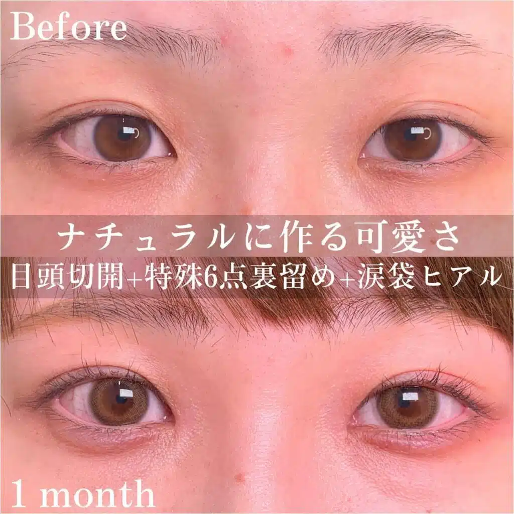 目頭切開　特殊6点裏留め　涙袋ヒアル　福岡