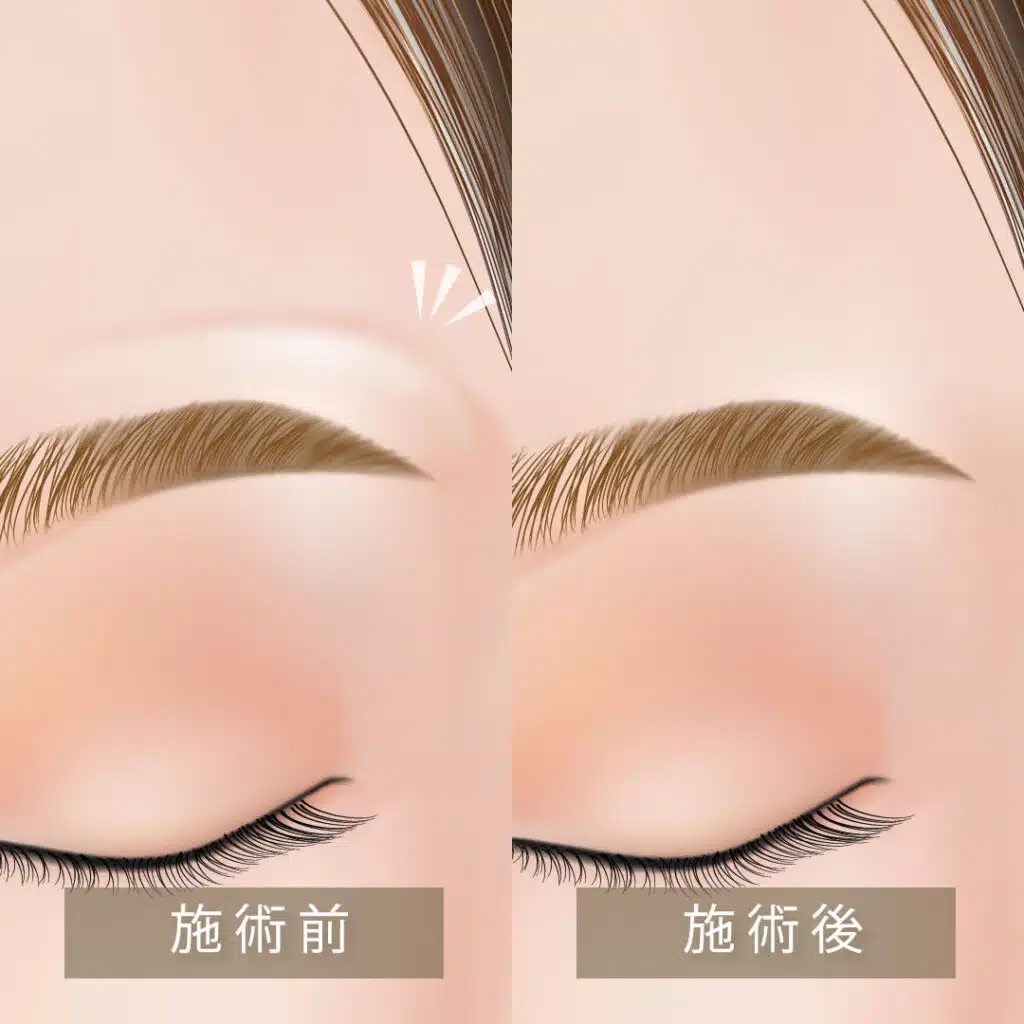 眉上ボトックス　福岡